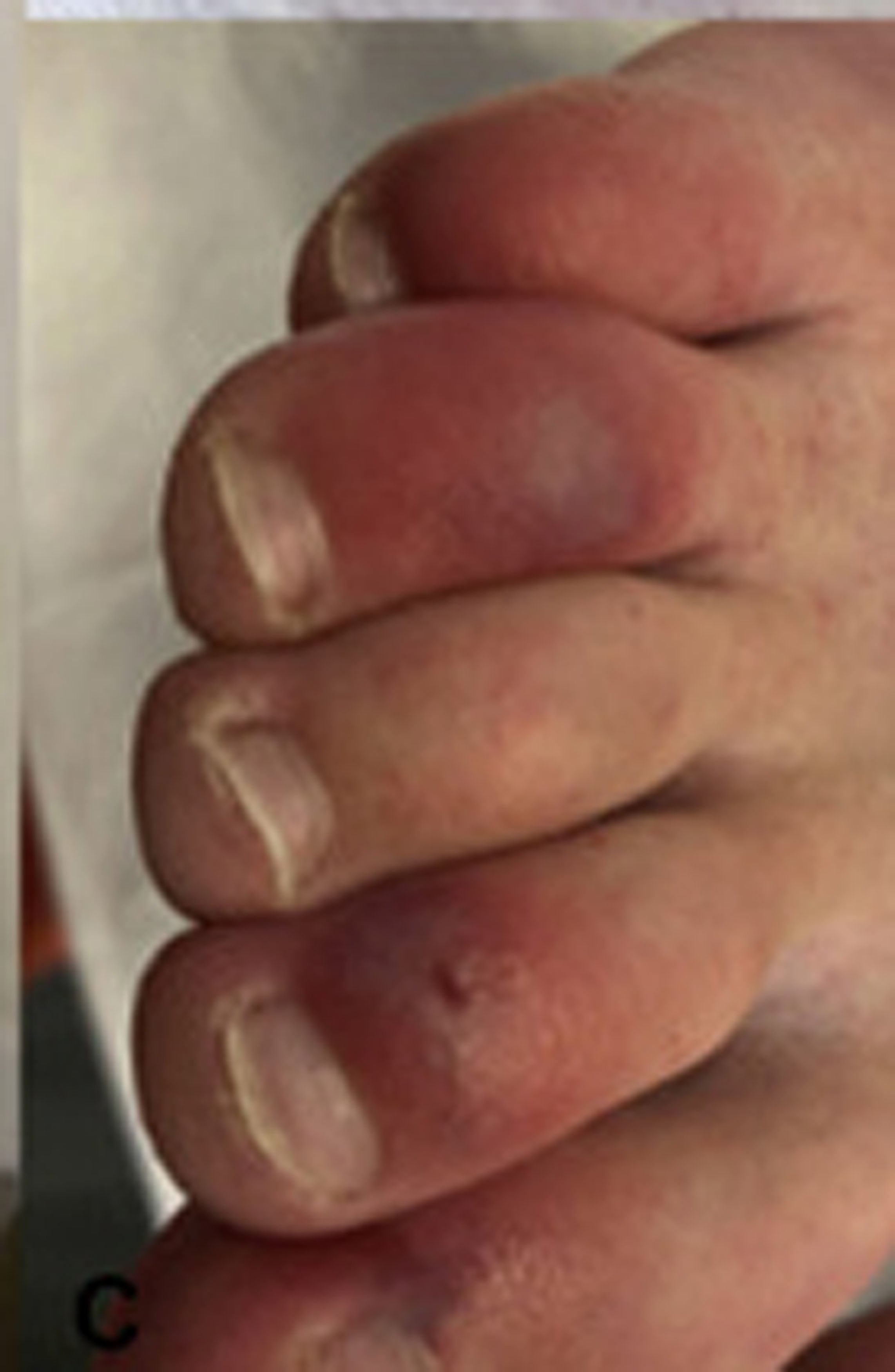 What Does It Mean If Your Toes Are Red And Swollen